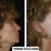 Thermage kezelés